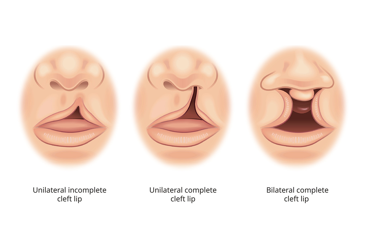 This illustration shows three side-by-side views of an infant’s mouth, nostrils and tip of the nose. One shows a unilateral incomplete cleft lip, with a gap forming an upside-down V from one side of the lip to under the nose. A depiction of a unilateral complete cleft lip shows a gap shaped like a river extending from one side of the mouth into the nostril above it. The depiction of a bilateral complete cleft lip shows a gap running from mouth to nose on both sides, flaring at each end.  