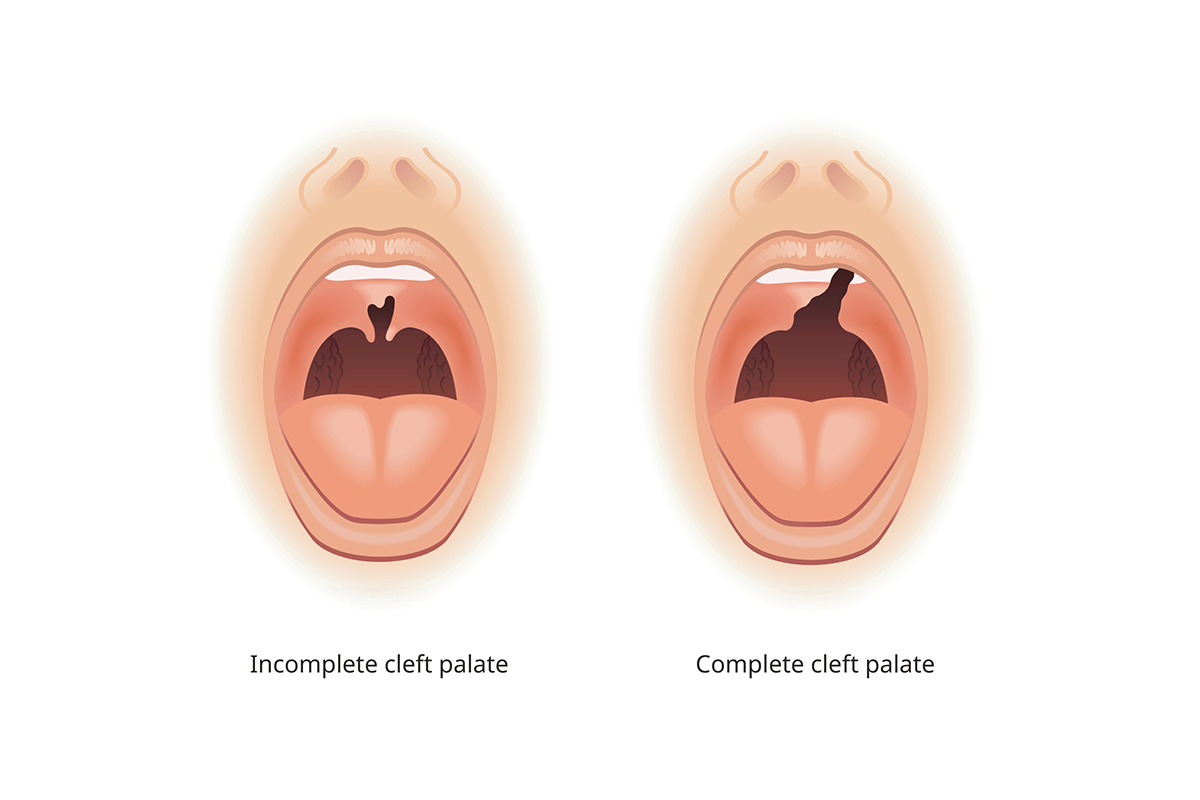 This illustration shows side-by-side views of an infant’s open mouth. One shows an incomplete cleft palate, with a roughly heart-shaped gap in the soft palate at the back of the mouth. The other shows a complete cleft palate, with the cleft running in a jagged diagonal line from the soft palate at the back of the mouth through the hard palate in the front.