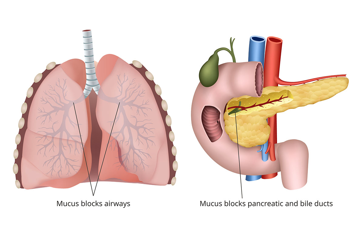A diagram of the human lungs and pancreas that illustrates mucus blockage in patients with cystic fibrosis.