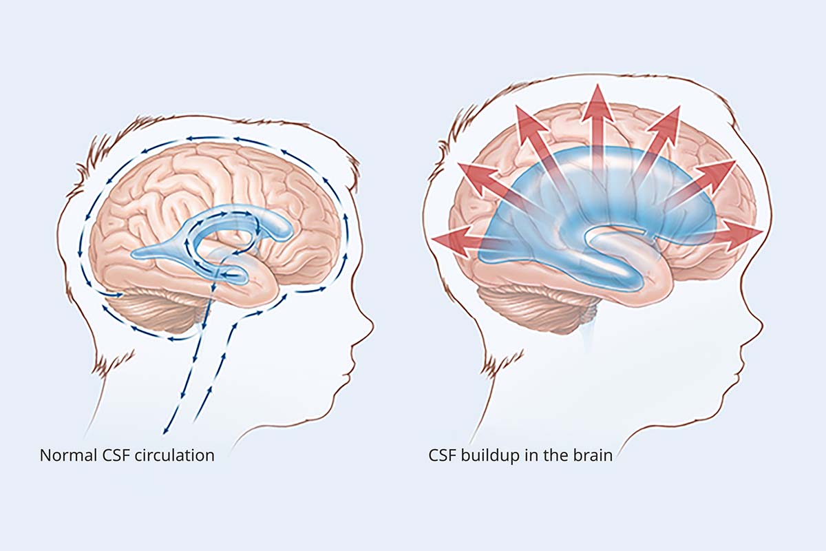 Illustration comparing normal central spinal fluid circulation with central spinal fluid buildup on the brain.
