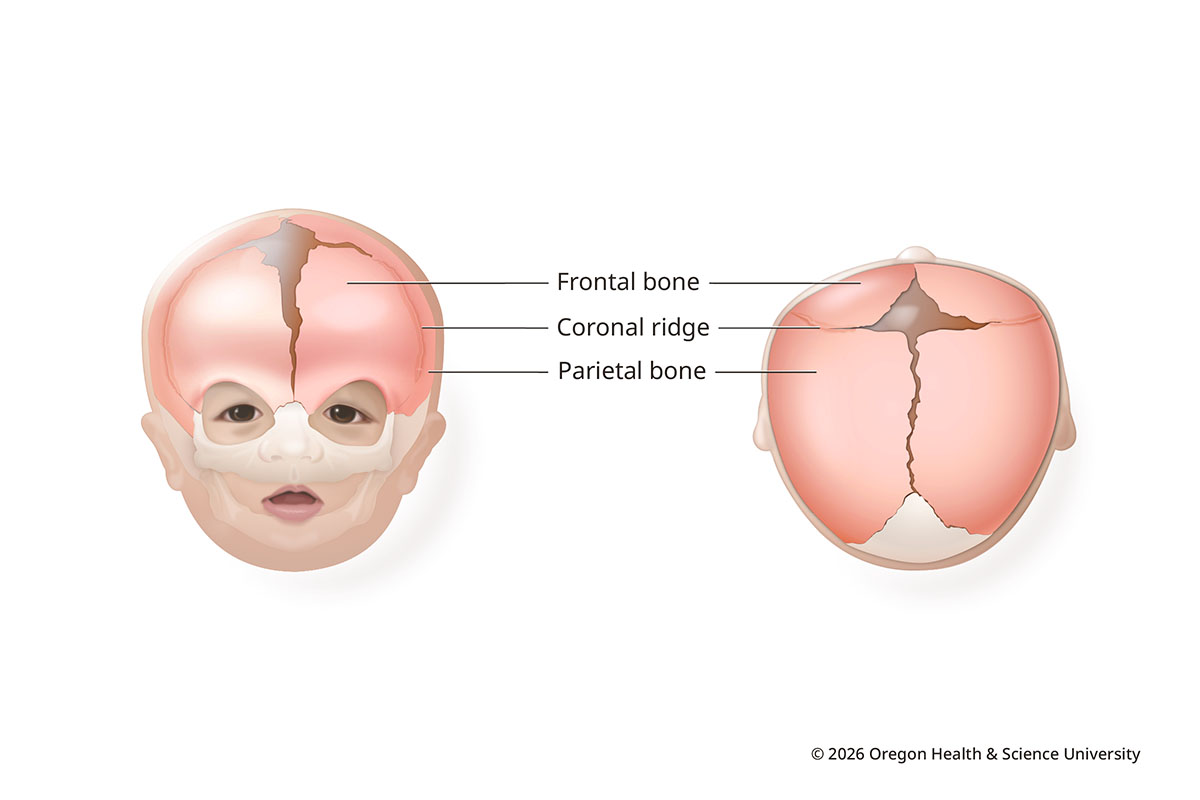 An illustration shows an infant skull with bilateral coronal synostosis from the front and from above. It shows how the head can be wide ear to ear and short front to back. With both sutures above the forehead closed, the forehead can't expand as the brain grows.