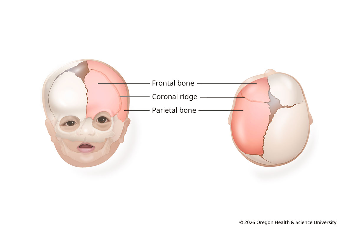 An illustration shows the skull of an infant with coronal synostosis from the front and from above. One of the coronal sutures, running from the ear up to the top of the head, is closed. The frontal and parietal bones are fused, from above eye level toward the top of the head. The affected eye socket is higher and longer. The unaffected side of the forehead protrudes.