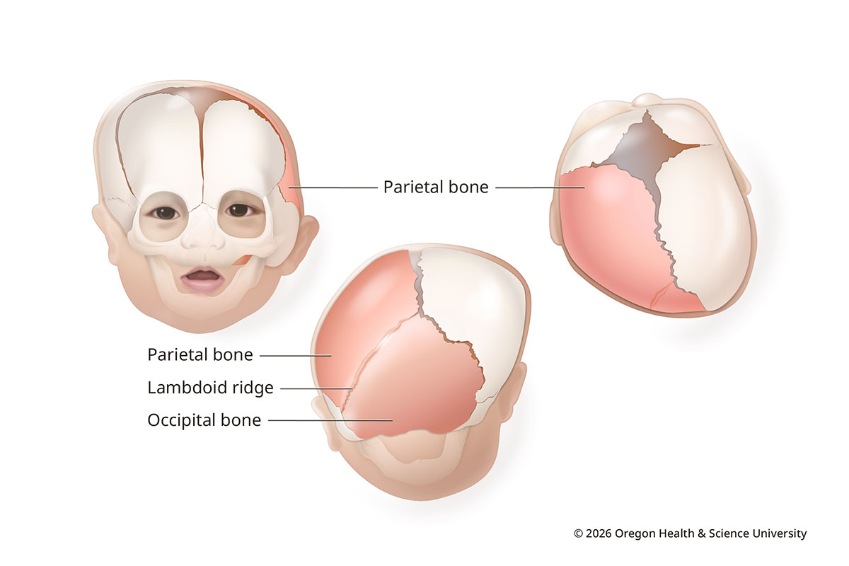 An illustration shows the skull of an infant with lambdoid synostosis from the front and from above. One of the lambdoid sutures is closed, fusing bones at the back of the skull. The forehead on the unaffected side bulges to make room for the brain. From above, the skull has a trapezoid shape.