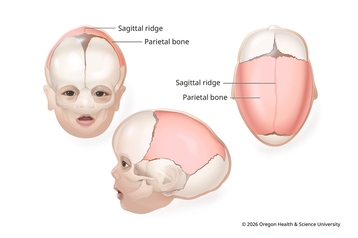 An illustration shows the skull of an infant with sagittal synostosis from the front, from the side and from above. The head is longer and narrower. The forehead and back of the head protrude. The parietal bones on each side have fused at the top of the head, forming a small ridge down the middle.