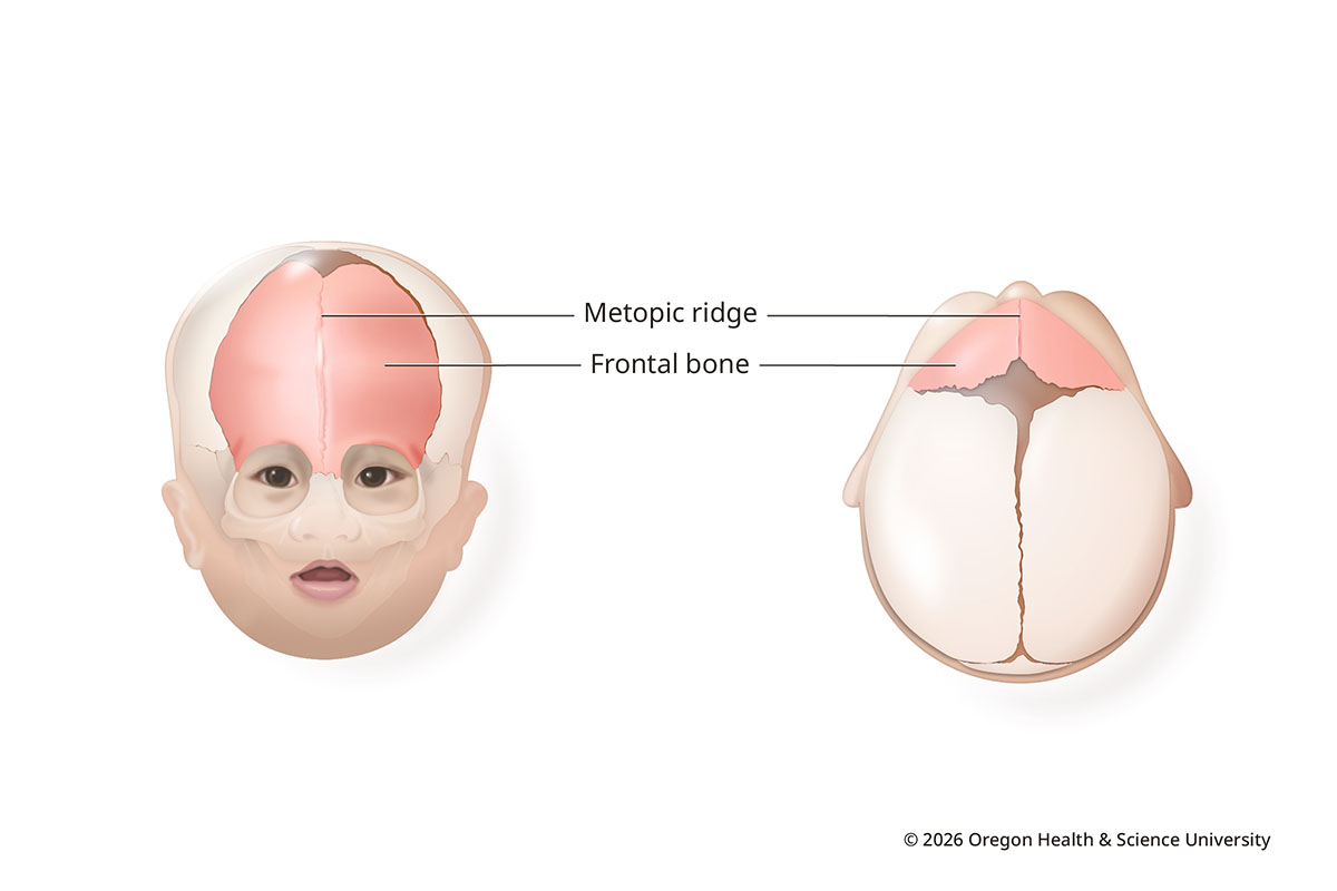 An illustration shows the skull of an infant with metopic synostosis from the front and from above. It shows how the metopic suture, a seam down the middle of the forehead between two bones, has closed early. The forehead's pointed shape is visible where the bones meet.