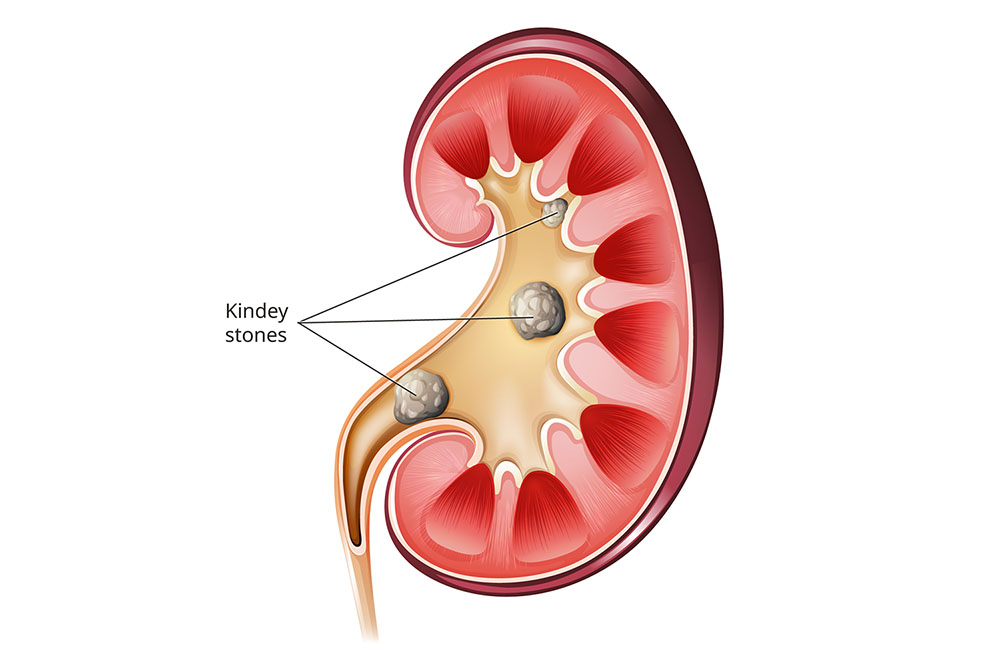 A diagram showing a kidney that has kidney stones.