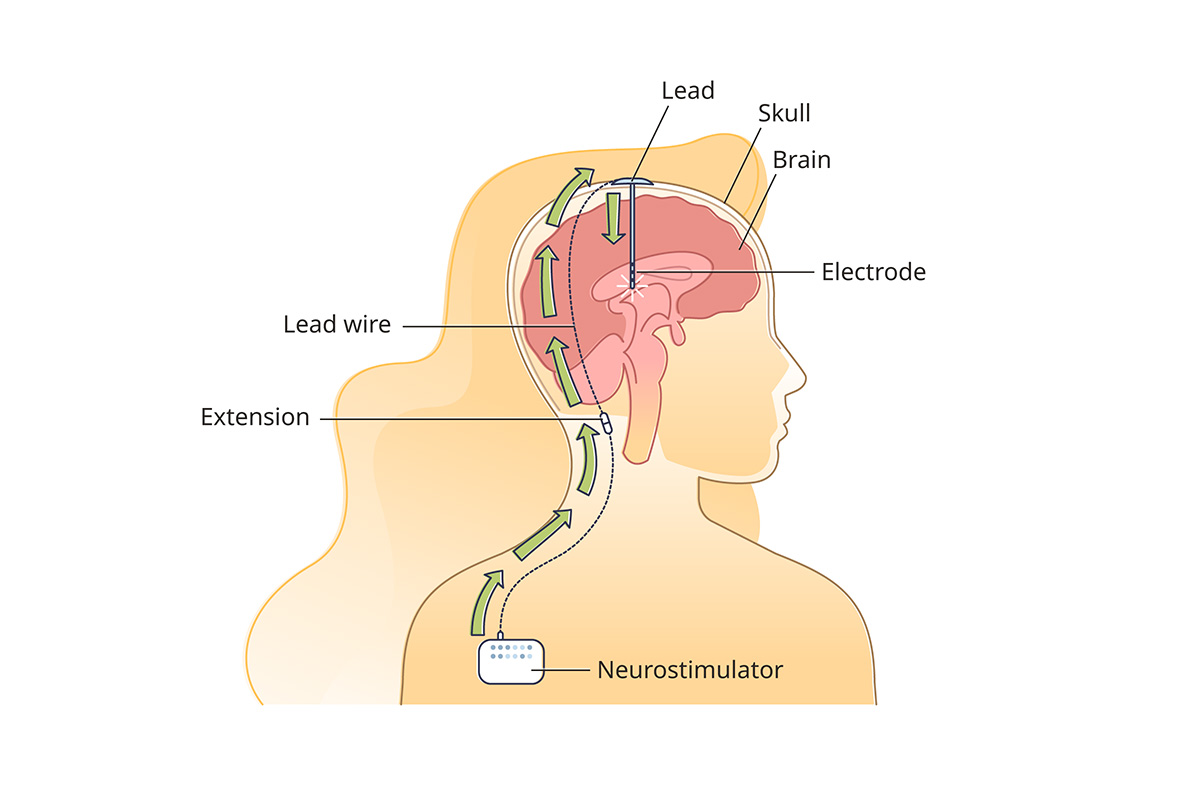 Diagram of brain stimulation, showing the placement of the lead, electrode, and neurostimulator