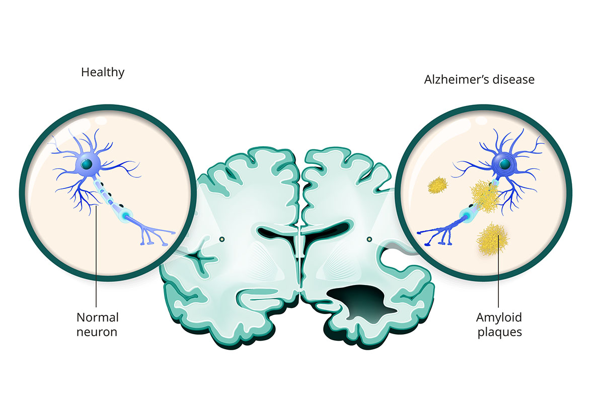 Medical Illustration of brain and neurons: Healthy vs. Alzheimer's disease.