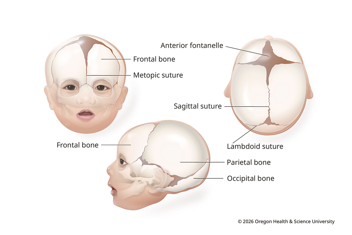 An illustration shows three views of a normally shaped infant skull, from the front, from the side and from above. It shows a diamond-shaped soft spot, or fontanelle, on top. Thin bands of soft tissue called sutures hold sections of bone together.