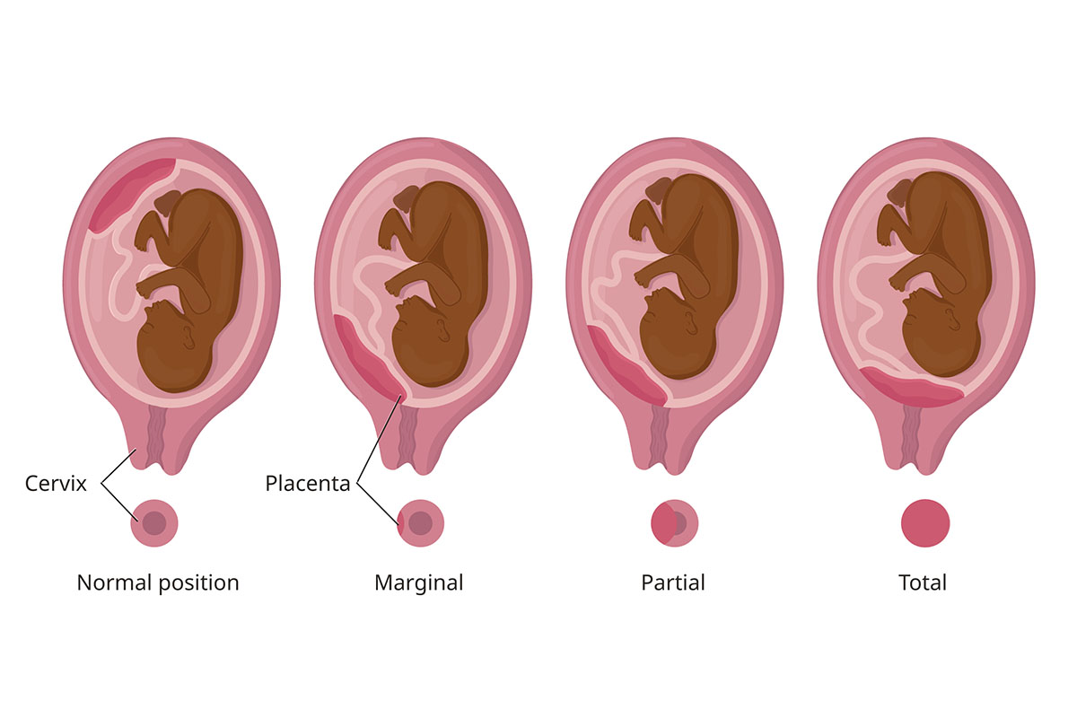 A diagram showing placenta previa at different levels of severity.