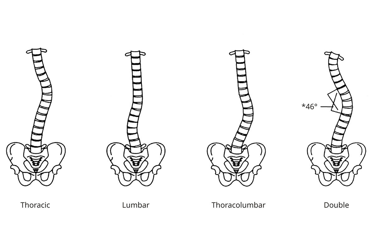 Medical illustration showing four scoliosis curve patterns. Three are C-shaped: thoracic (midback), lumbar (lower back), and thoracolumbar (midback and lower back). The fourth is a double curve forming an S-shaped spine.