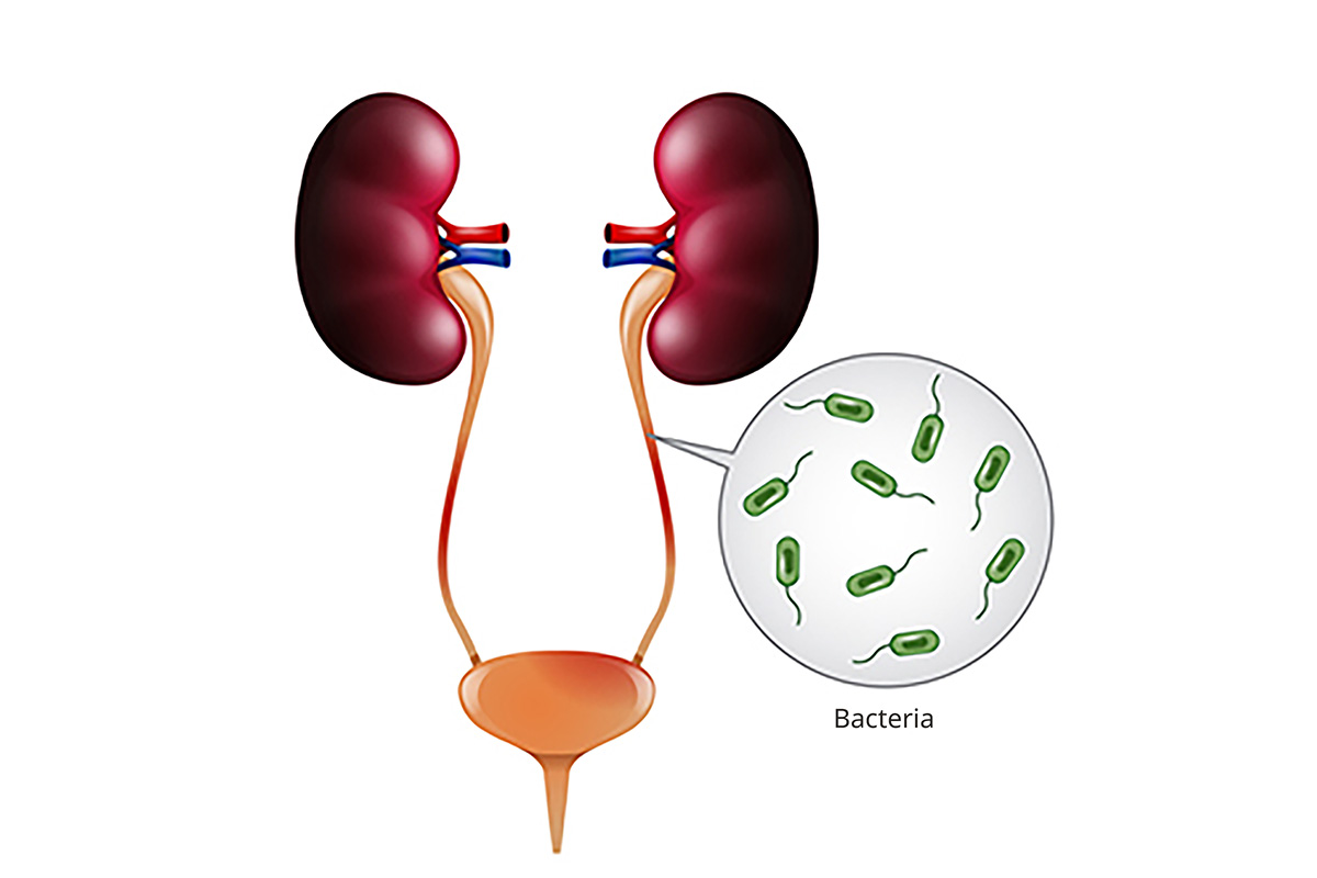 A medical illustration of the urinary tract, showing kidneys, bladder, and the tubes — or ureters — that connect them. A circular callout pointing to a ureter shows a magnified view of bacteria.