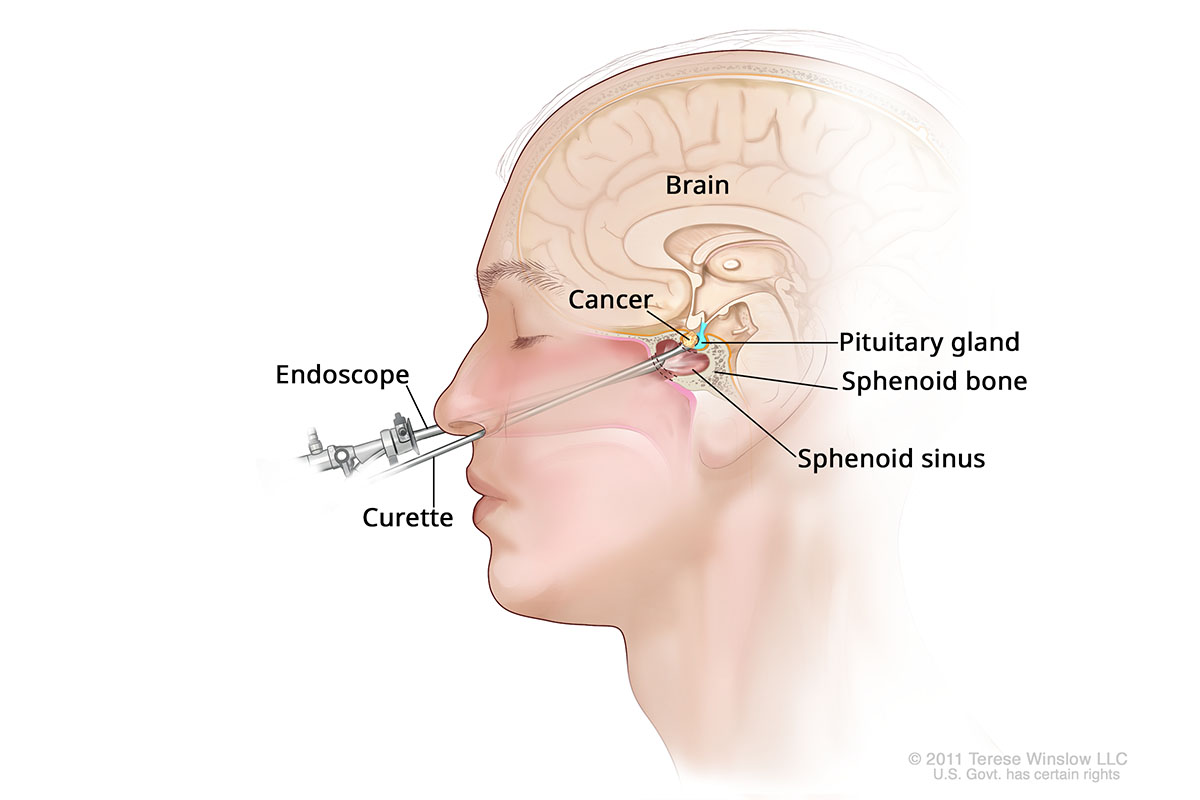 A diagram of a transsphenoidal surgery shows a side cutaway of a human head. Long, thin metal instruments enter the nose and reach the pituitary gland at the base of the brain.