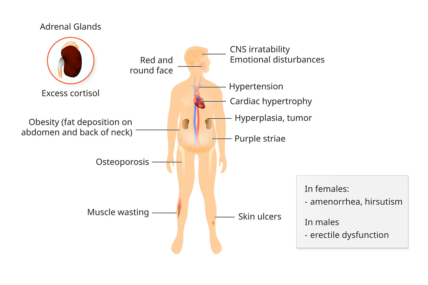 Diagram of Cushings Syndrome (Cushing's Syndrome) symptoms.